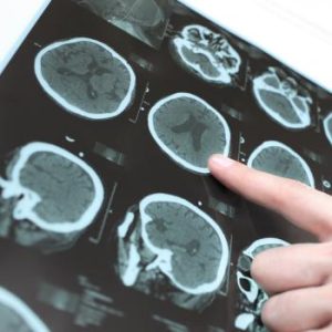 Brain scan