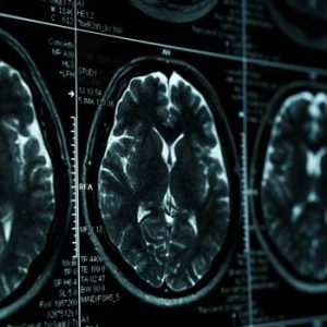 Sepsis and Brain Injuries
