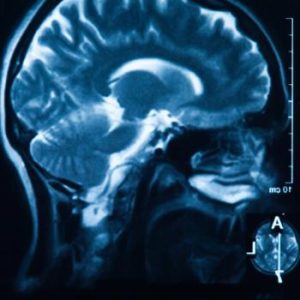 Mild Brain Injury Concussions